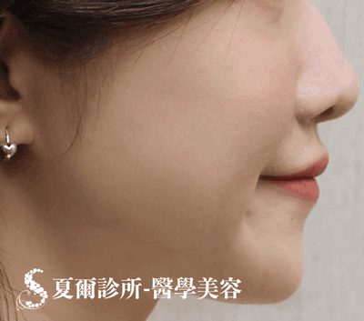 舒顏萃蘋果肌_術後照