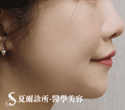舒顏萃蘋果肌_術前照