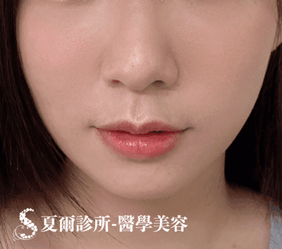 線雕拉提嘴邊肉_術後照