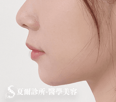 線雕拉提嘴邊肉_術後照