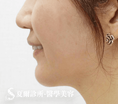 線雕拉提嘴邊肉_術後照