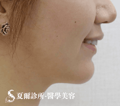 線雕拉提嘴邊肉_術後照