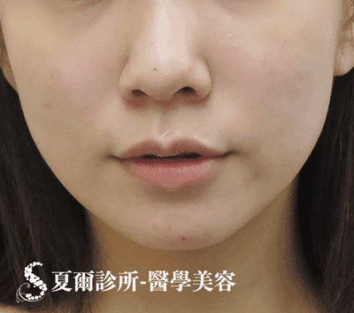 線雕拉提嘴邊肉_術前照