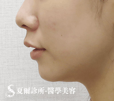 線雕拉提嘴邊肉_術前照