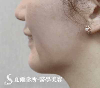 線雕拉提嘴邊肉_術前照
