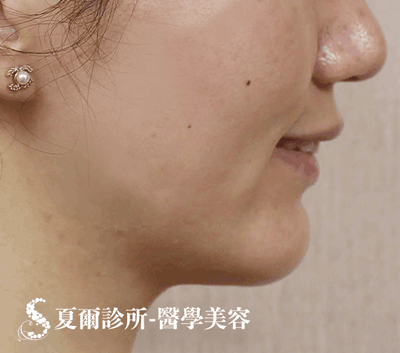 線雕拉提嘴邊肉_術前照